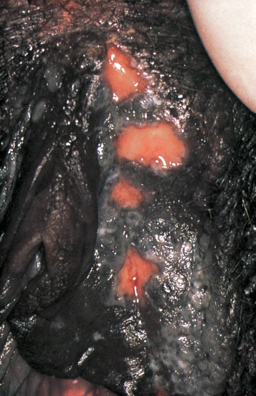 Genital Herpes (Ulcerations)