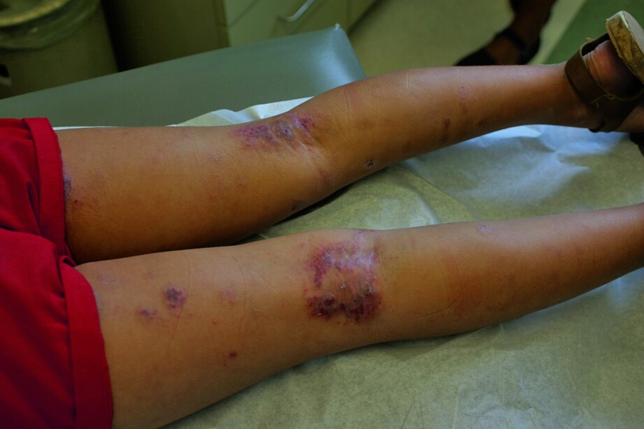 Atopic Dermatitis (Popliteal Fossa)