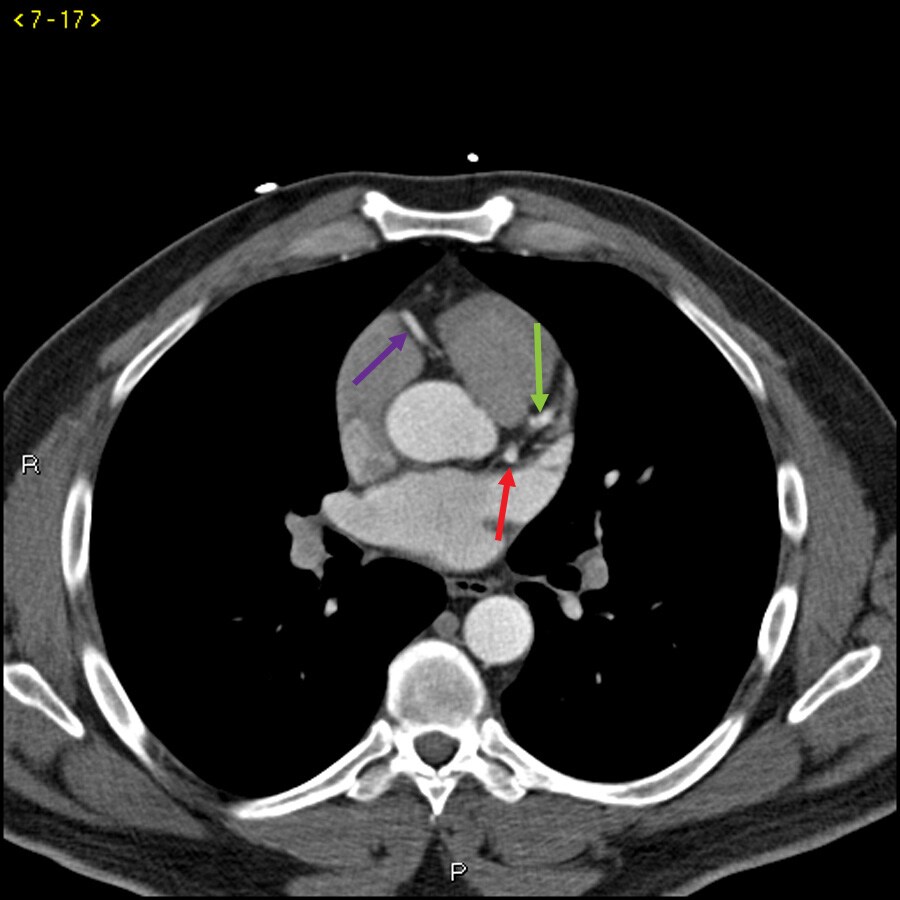 Contrast CT Showing Normal Coronary Arteries – Slide 2