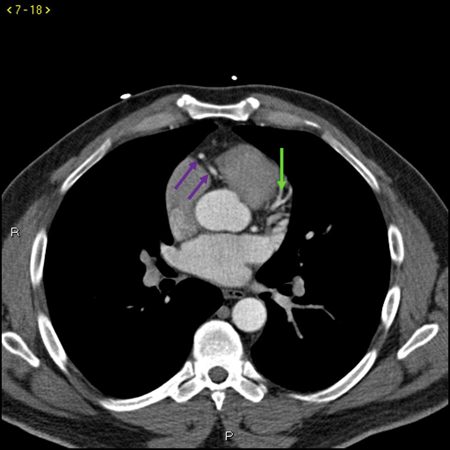 Contrast CT Showing Normal Coronary Arteries – Slide 3