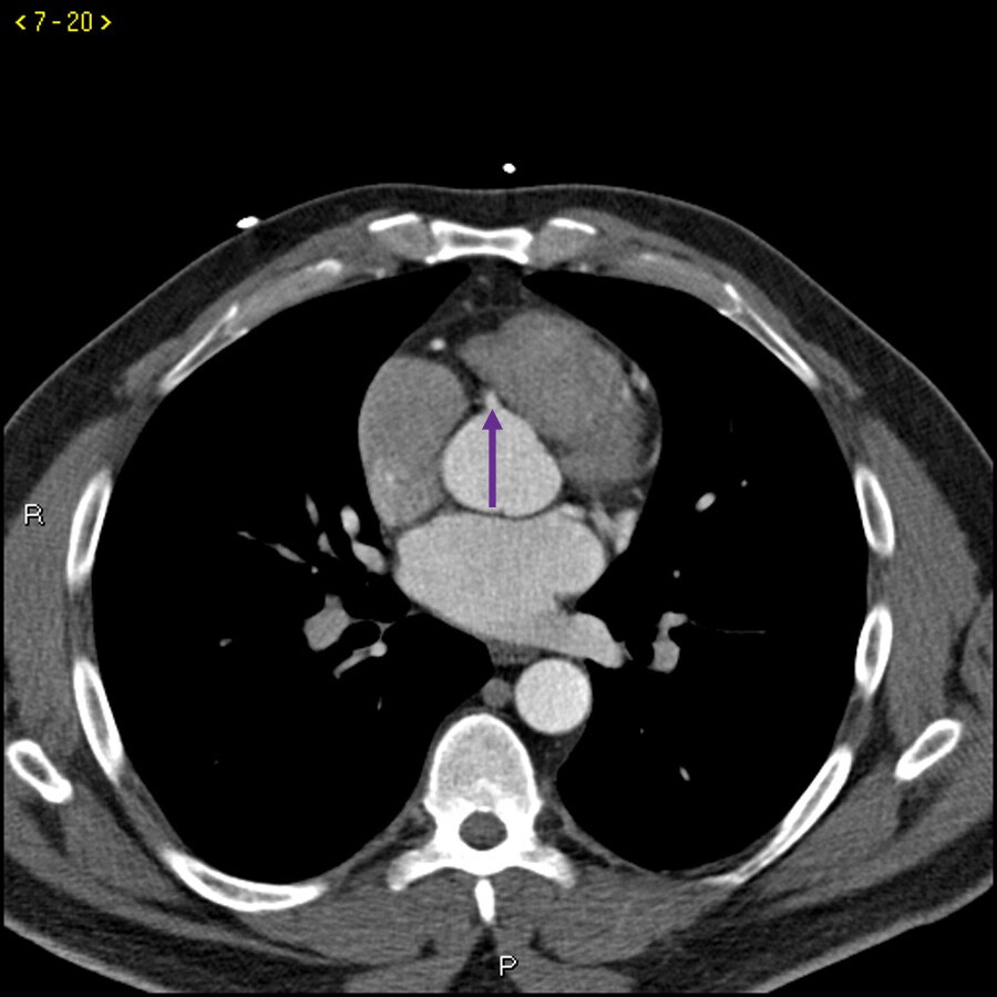 Contrast CT Showing Normal Coronary Arteries – Slide 5