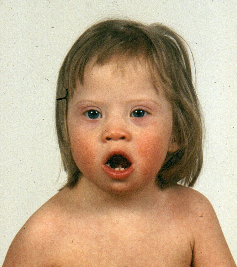 Down Syndrome (Facial Features)