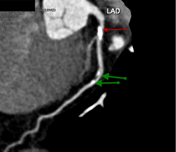 Contrast CT Showing Coronary Artery Disease