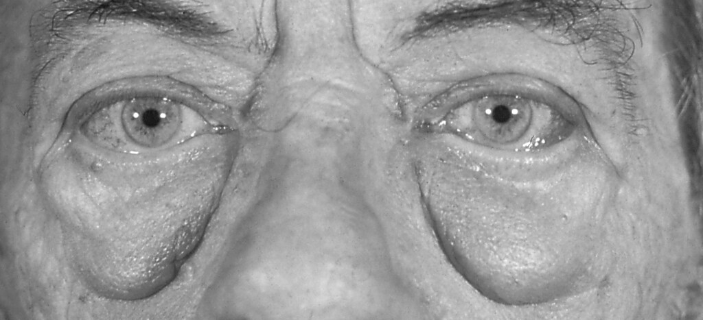 Eye Manifestations of Graves Disease—Infraorbital Bags