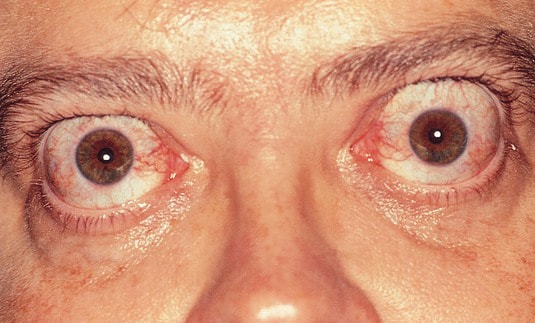 Close-up View of Exophthalmos