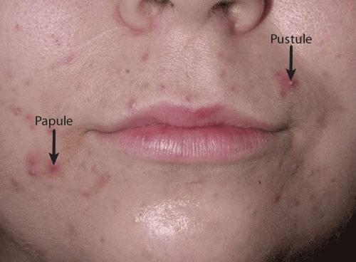 Acne (Papules and Pustules)