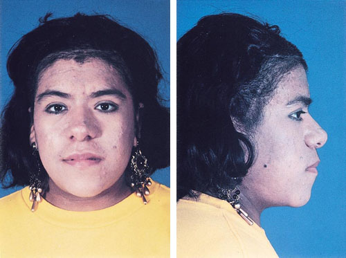 Acromegaly (Frontal and Lateral Views of Facial Changes)