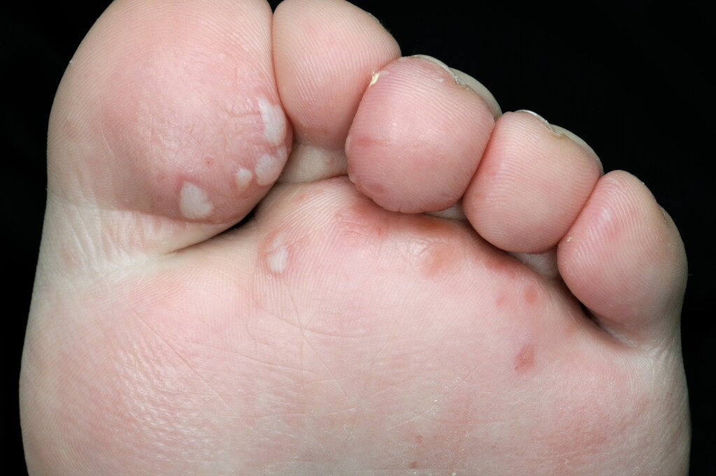 Hand-Foot-and-Mouth Disease (Foot Lesions)