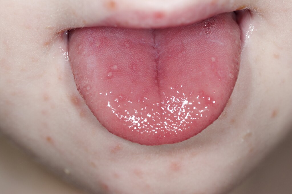 Hand-Foot-and-Mouth Disease (Oral and Facial Lesions)
