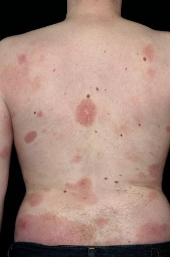 Mycosis Fungoides (Back)