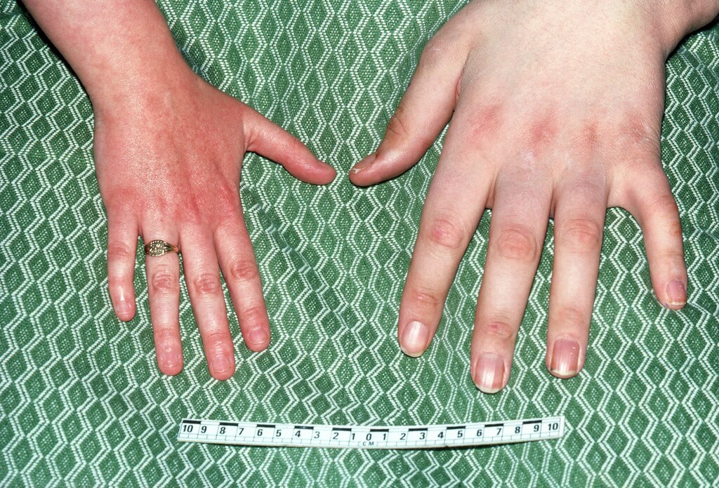 Acromegaly (Hand Findings)