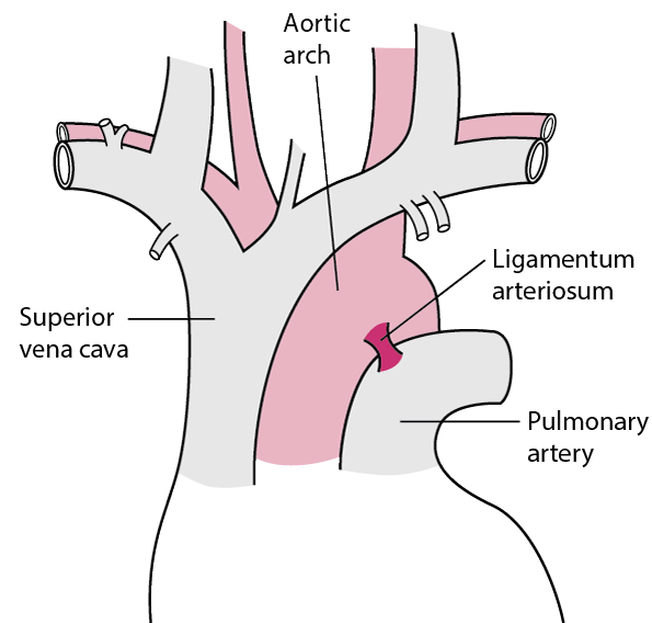Most partial ruptures of the aorta occur near the ligamentum arteriosum