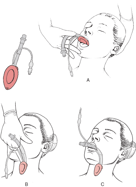 Laryngeal mask airway (LMA)