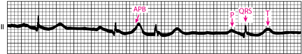 Atrial premature beat (APB)