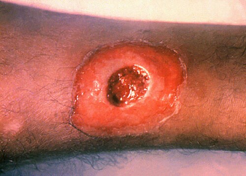 Cutaneous Diphtheria (Central Ulceration)