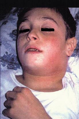 Diphtheria (Nasopharyngeal With Bull Neck)