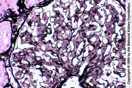 Fibrillary Glomerulopathy (Mesangial Proliferation)