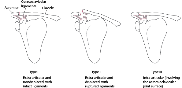 Class B clavicular fractures