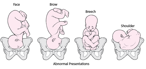 Position and presentation of the fetus
