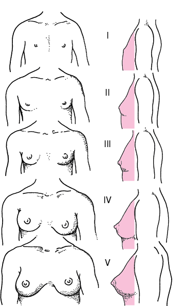 Diagrammatic representation of Tanner stages I to V of human breast maturation