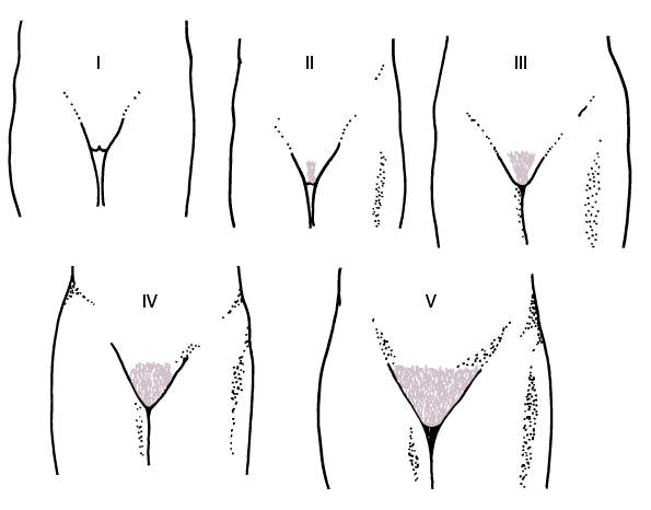 Diagrammatic representation of Tanner stages I to V for development of pubic hair in girls