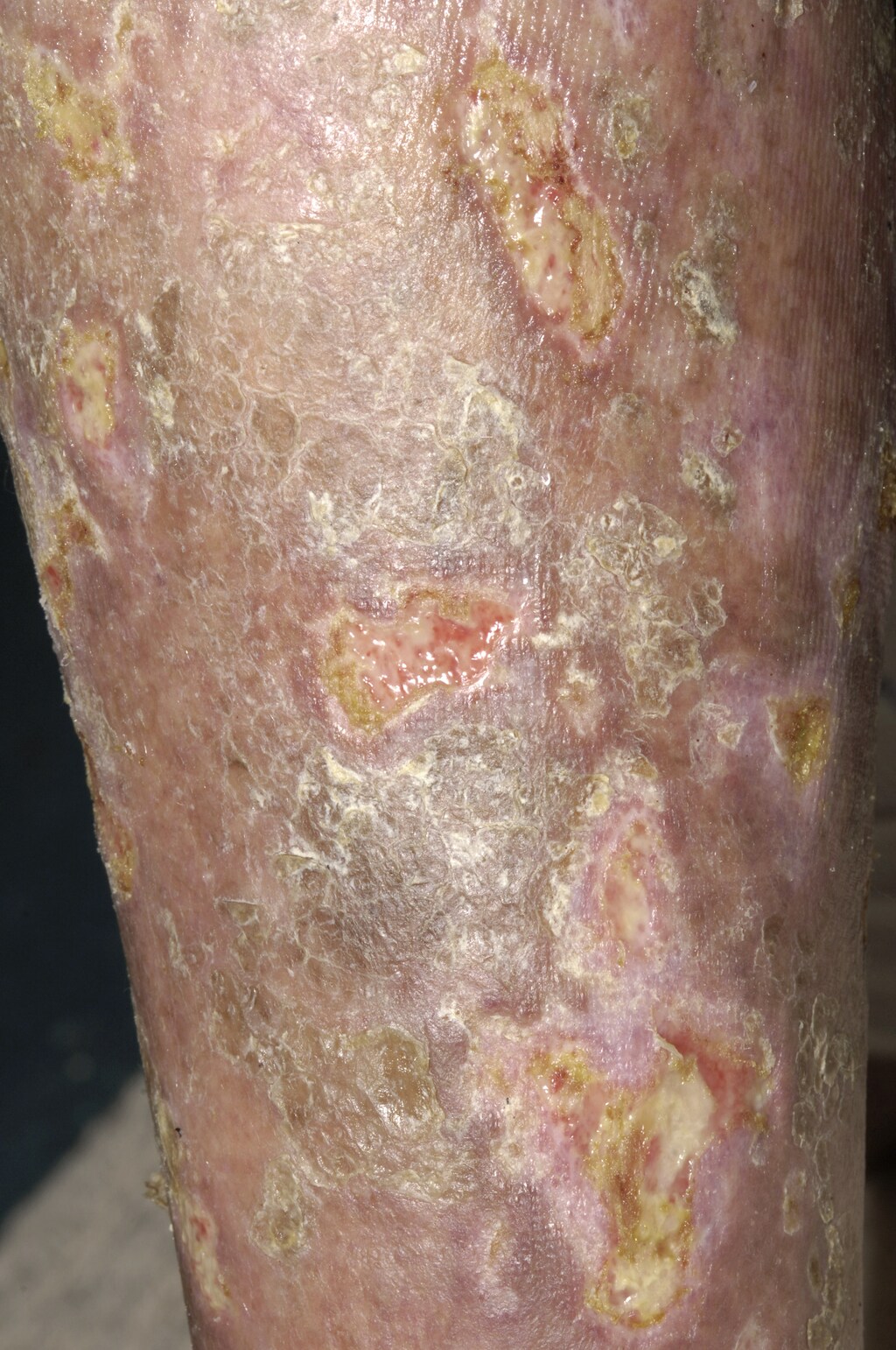 Mycosis Fungoides with Ulceration