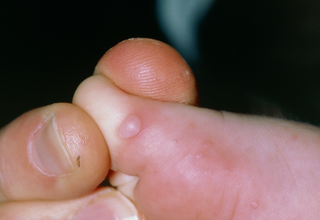 Coxsackie Virus A Exanthem (Foot Lesions)