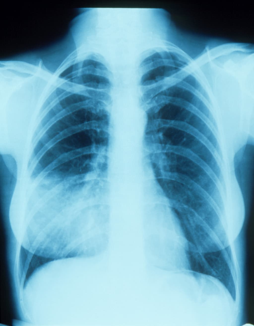 Pneumonia of the Right Middle Lobe With Silhouette Sign