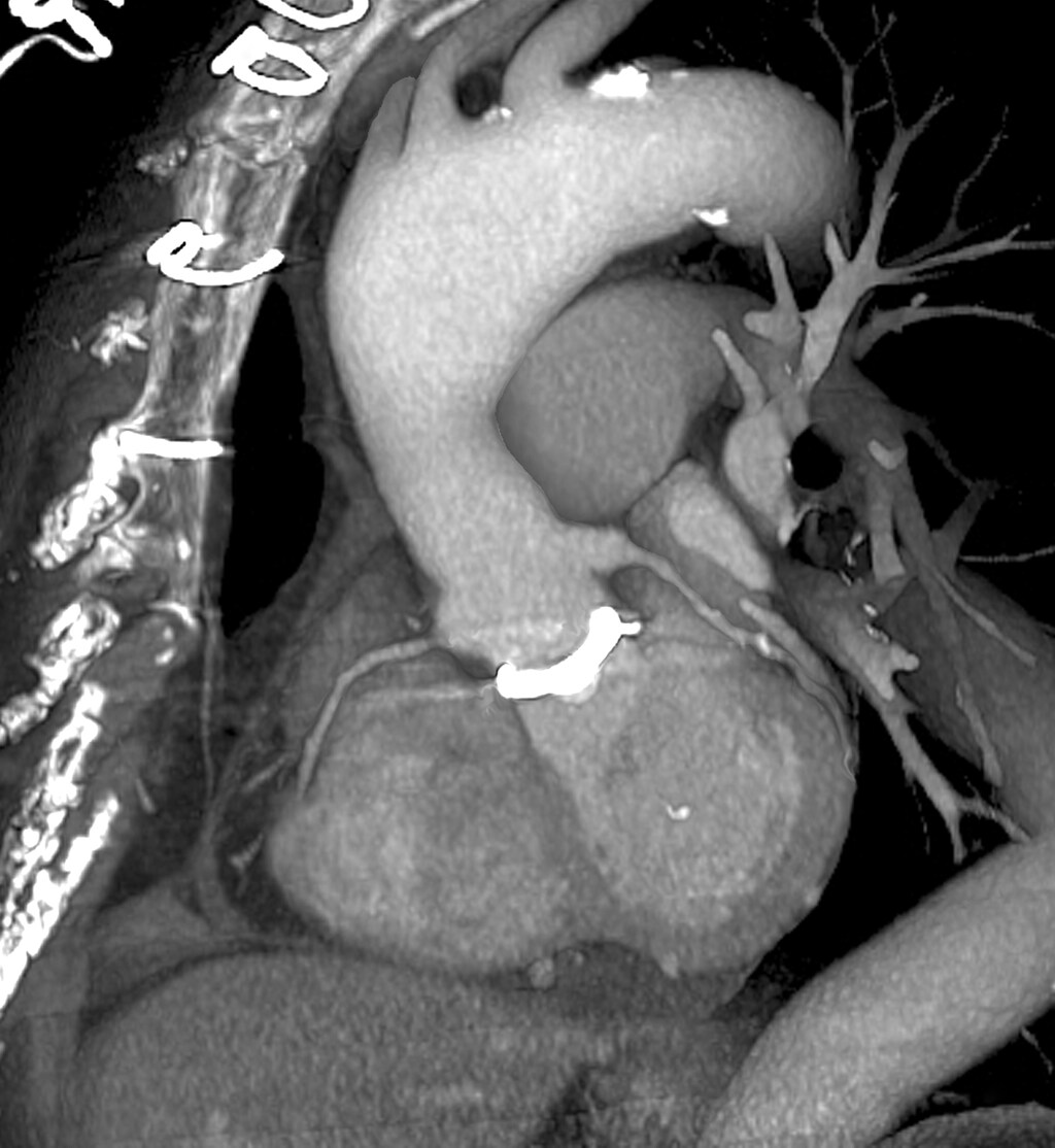 Cardiac CT (3D Scan of Prosthetic Heart Valve)