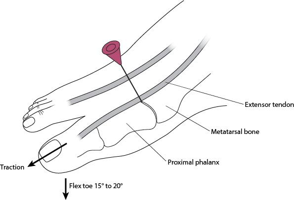 Arthrocentesis of the metatarsophalangeal joint