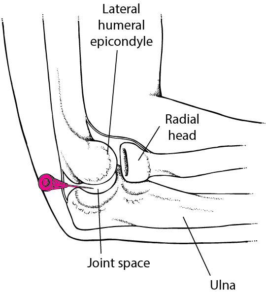 Arthrocentesis of the elbow