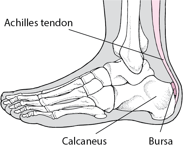 Bursitis in the heel