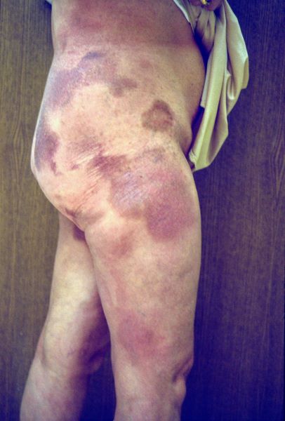 Mycosis Fungoides (Trunk and Leg)