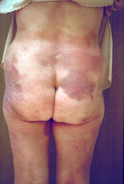 Mycosis Fungoides (Buttocks)
