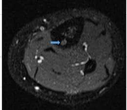 Osteoid Osteoma of the Tibia (MRI)