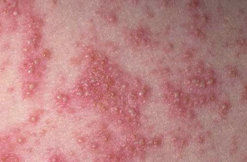 Possible complications for psoriasis. Psoriasis vulgaris g