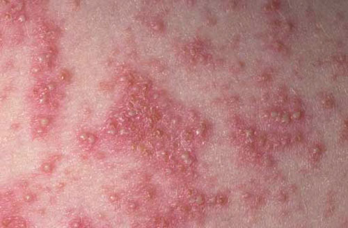 lehet alkoholmentes sör psoriasis, Balzsam tiszta br psoriasis