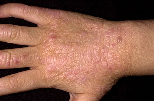 Skin Lesion (Lichenification)