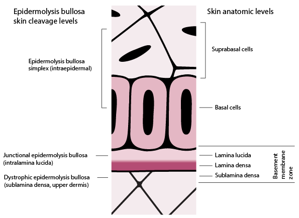 Skin cleavage levels in epidermolysis bullosa