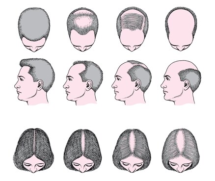Male- and female-pattern hair loss (androgenetic alopecia)