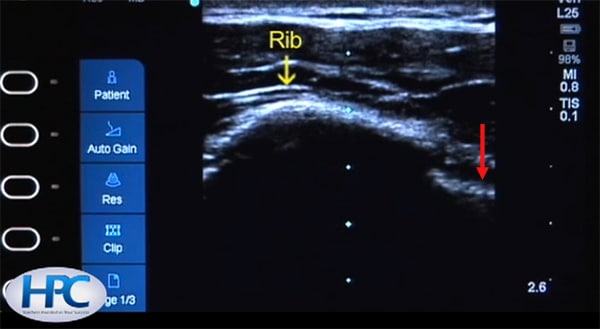 Ultrasound Appearance of Ribs and Pleural Line